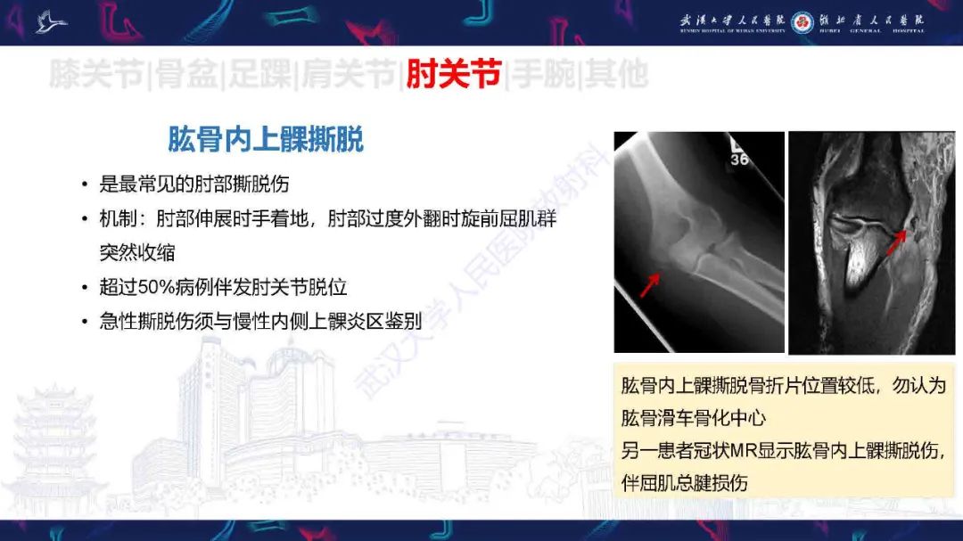 影像PPT - 【PPT】骨关节撕脱性损伤影像诊断-41