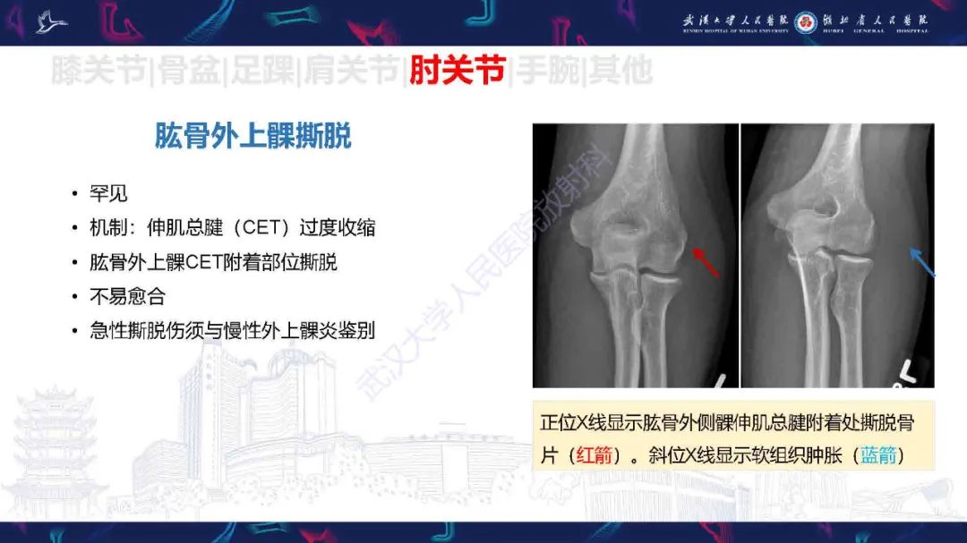 影像PPT - 【PPT】骨关节撕脱性损伤影像诊断-42