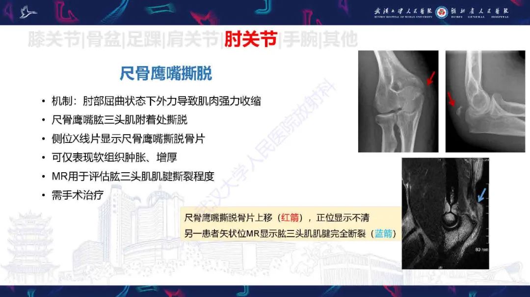 影像PPT - 【PPT】骨关节撕脱性损伤影像诊断-43