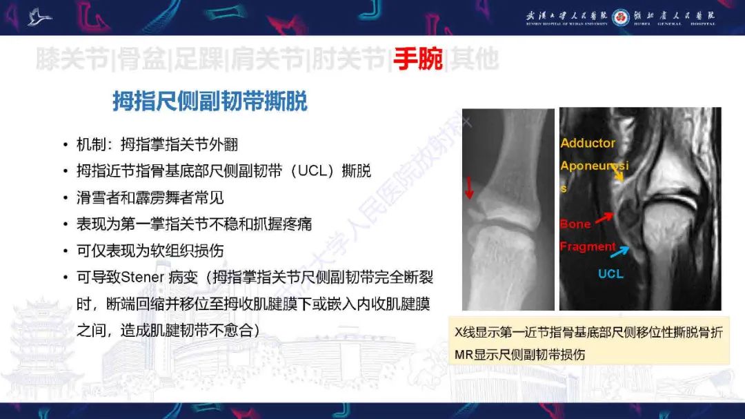 影像PPT - 【PPT】骨关节撕脱性损伤影像诊断-44