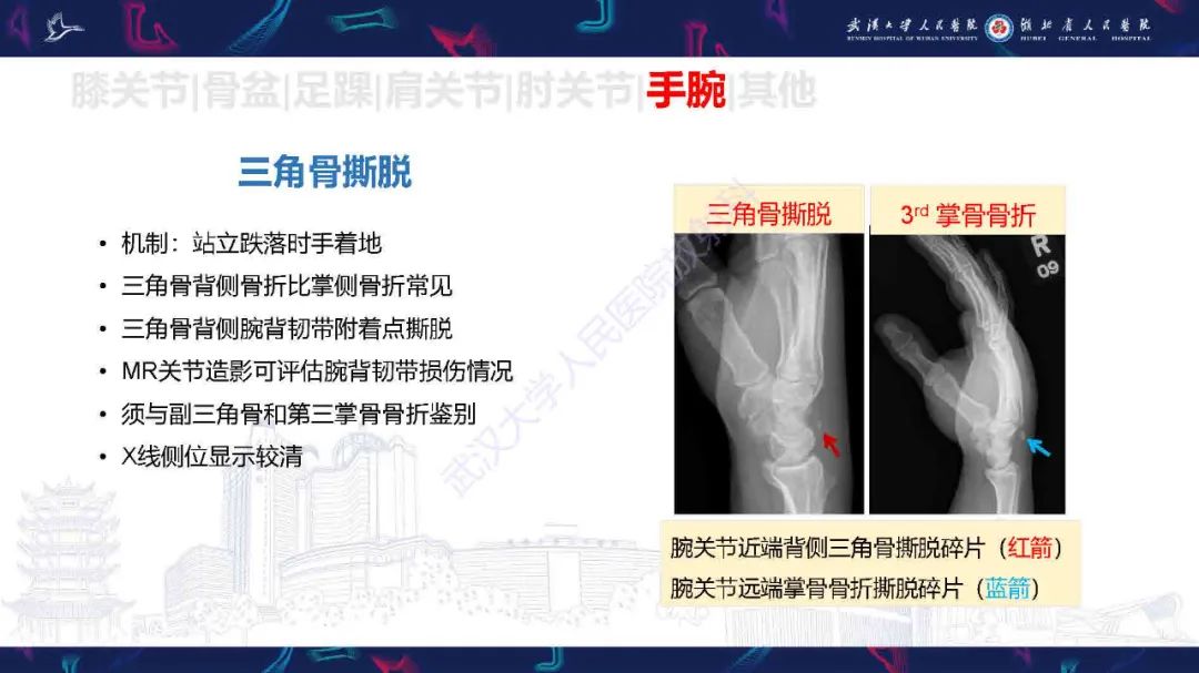 影像PPT - 【PPT】骨关节撕脱性损伤影像诊断-45