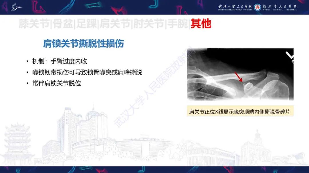影像PPT - 【PPT】骨关节撕脱性损伤影像诊断-47