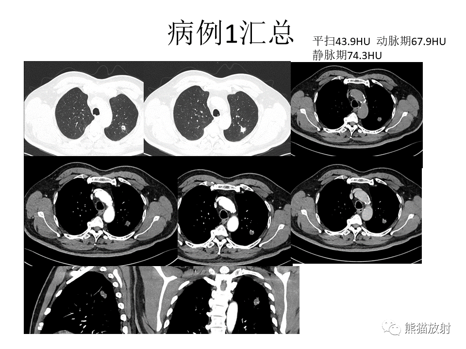 影像PPT - 【病例】肺结核肉芽肿 VS 肺腺癌-3