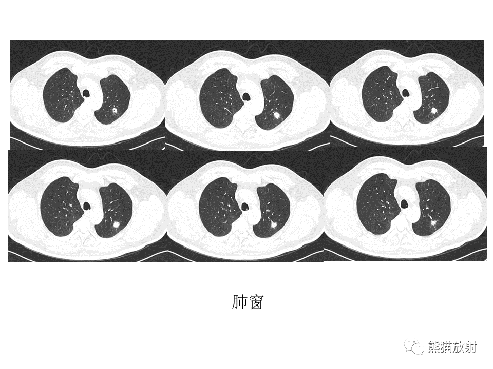 影像PPT - 【病例】肺结核肉芽肿 VS 肺腺癌-4