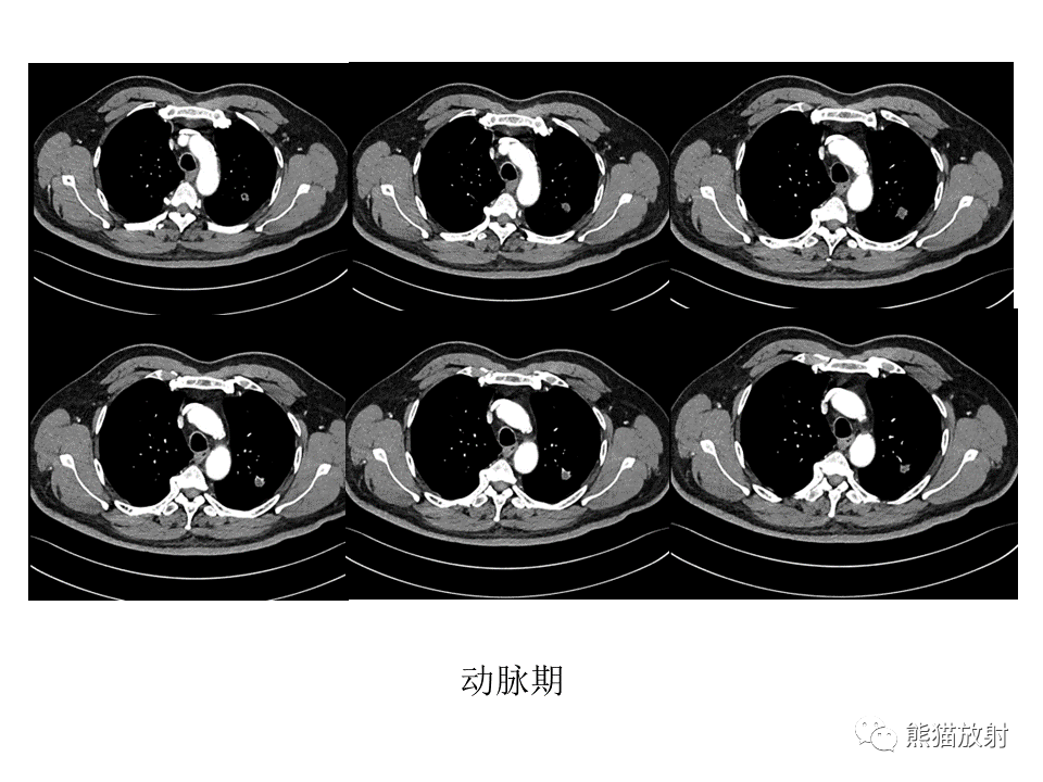 影像PPT - 【病例】肺结核肉芽肿 VS 肺腺癌-5