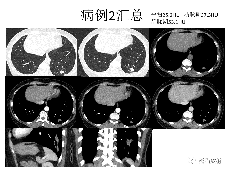 影像PPT - 【病例】肺结核肉芽肿 VS 肺腺癌-9