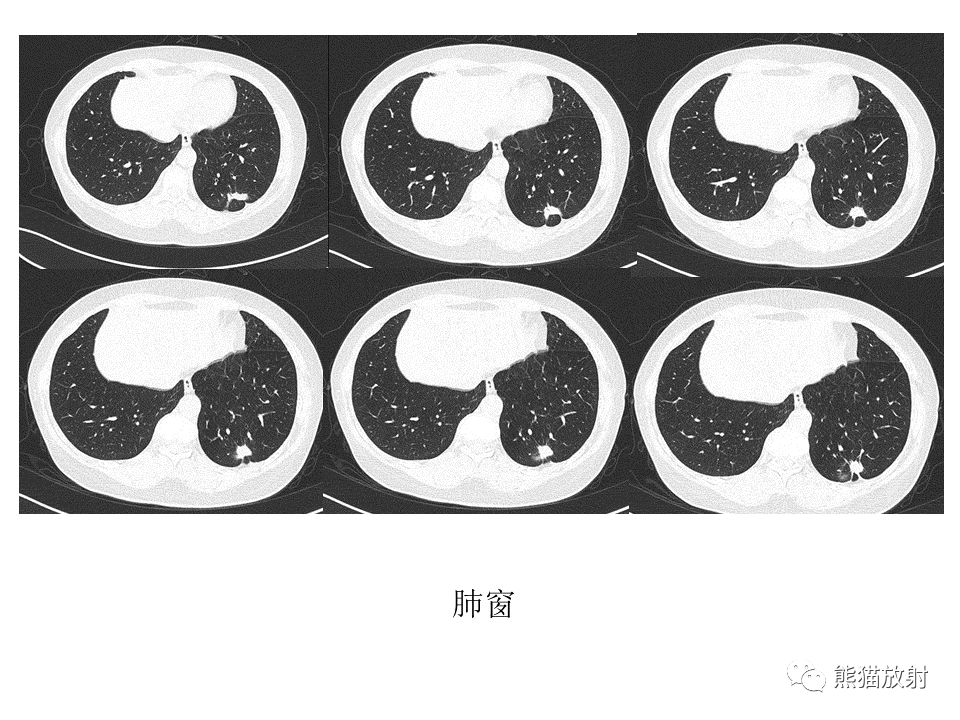 影像PPT - 【病例】肺结核肉芽肿 VS 肺腺癌-10