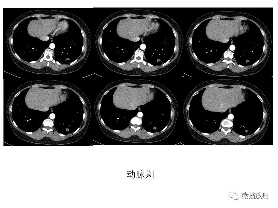 影像PPT - 【病例】肺结核肉芽肿 VS 肺腺癌-11