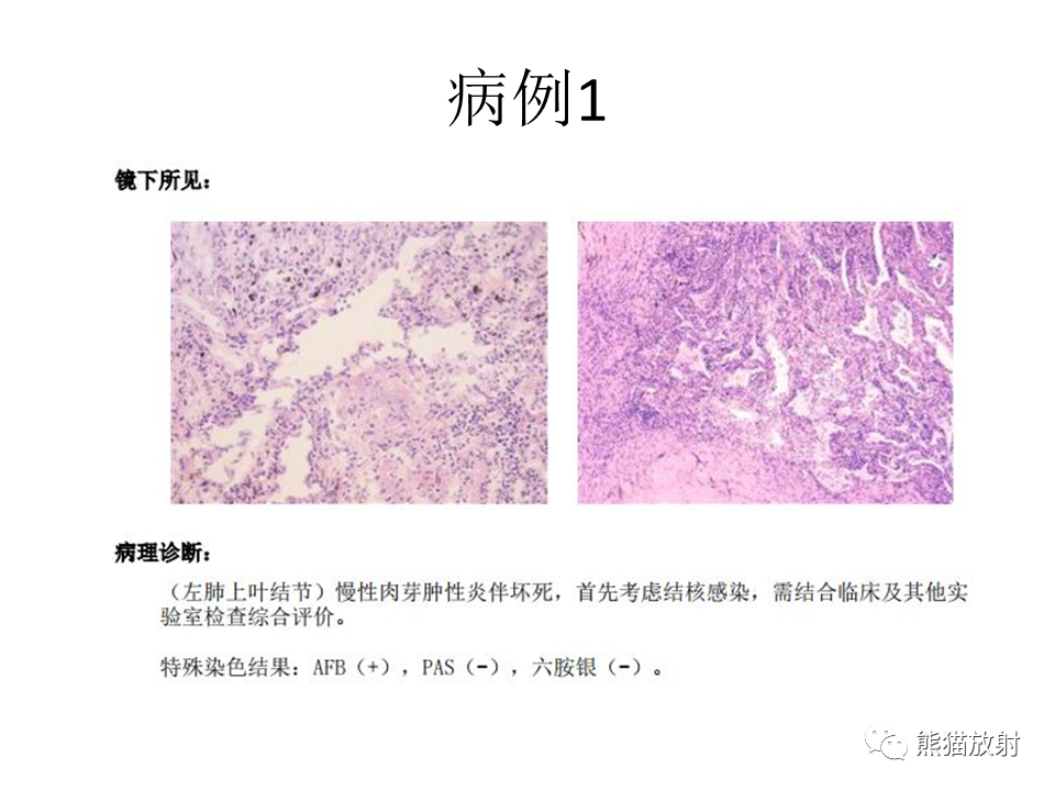 影像PPT - 【病例】肺结核肉芽肿 VS 肺腺癌-13