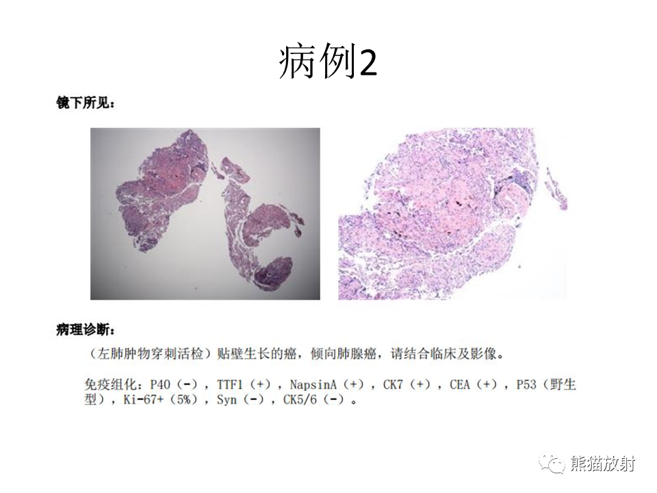 影像PPT - 【病例】肺结核肉芽肿 VS 肺腺癌-14