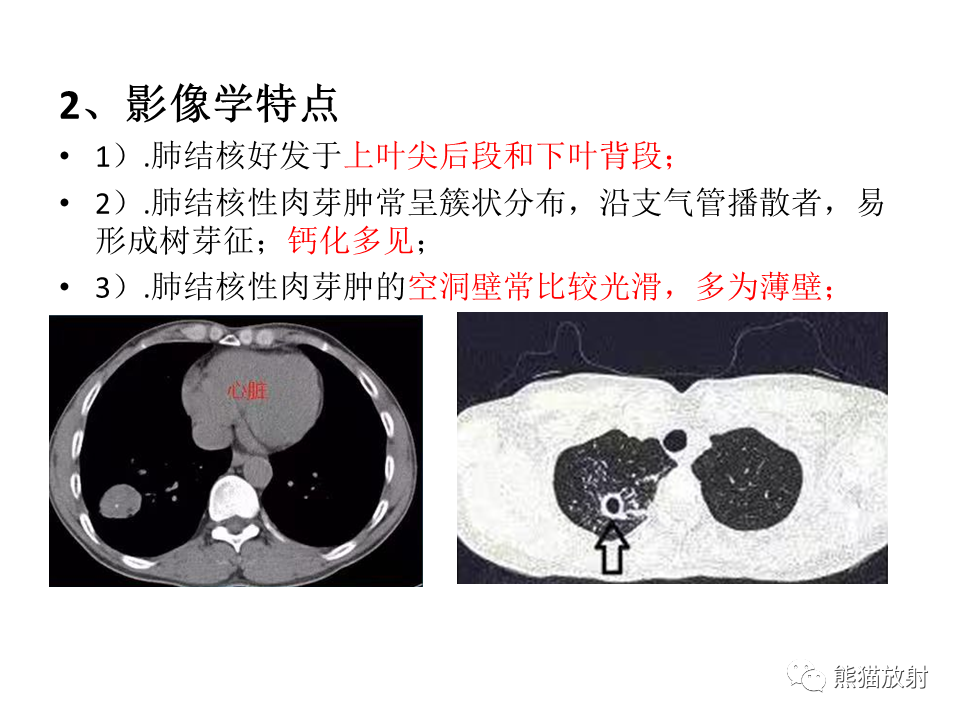 影像PPT - 【病例】肺结核肉芽肿 VS 肺腺癌-25