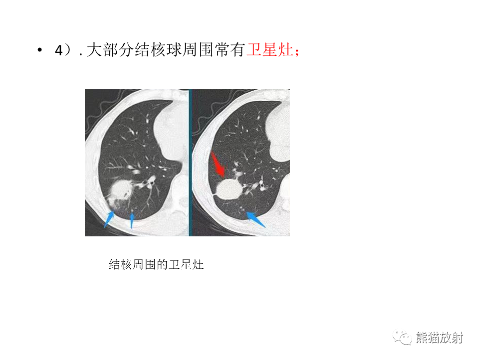 影像PPT - 【病例】肺结核肉芽肿 VS 肺腺癌-26