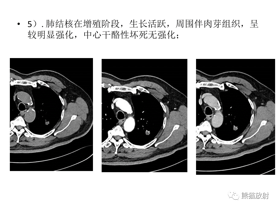 影像PPT - 【病例】肺结核肉芽肿 VS 肺腺癌-27