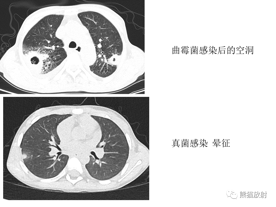 影像PPT - 【病例】肺结核肉芽肿 VS 肺腺癌-30