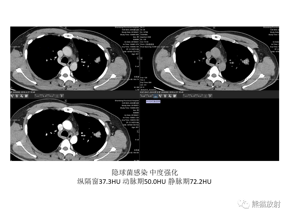 影像PPT - 【病例】肺结核肉芽肿 VS 肺腺癌-31