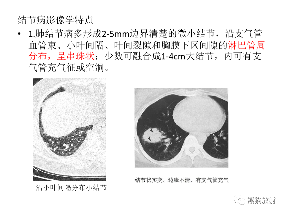 影像PPT - 【病例】肺结核肉芽肿 VS 肺腺癌-33