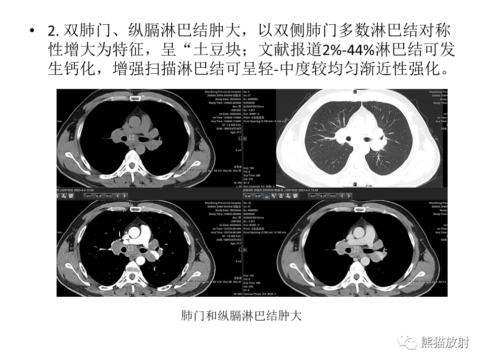 影像PPT - 【病例】肺结核肉芽肿 VS 肺腺癌-34