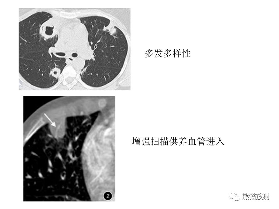 影像PPT - 【病例】肺结核肉芽肿 VS 肺腺癌-37