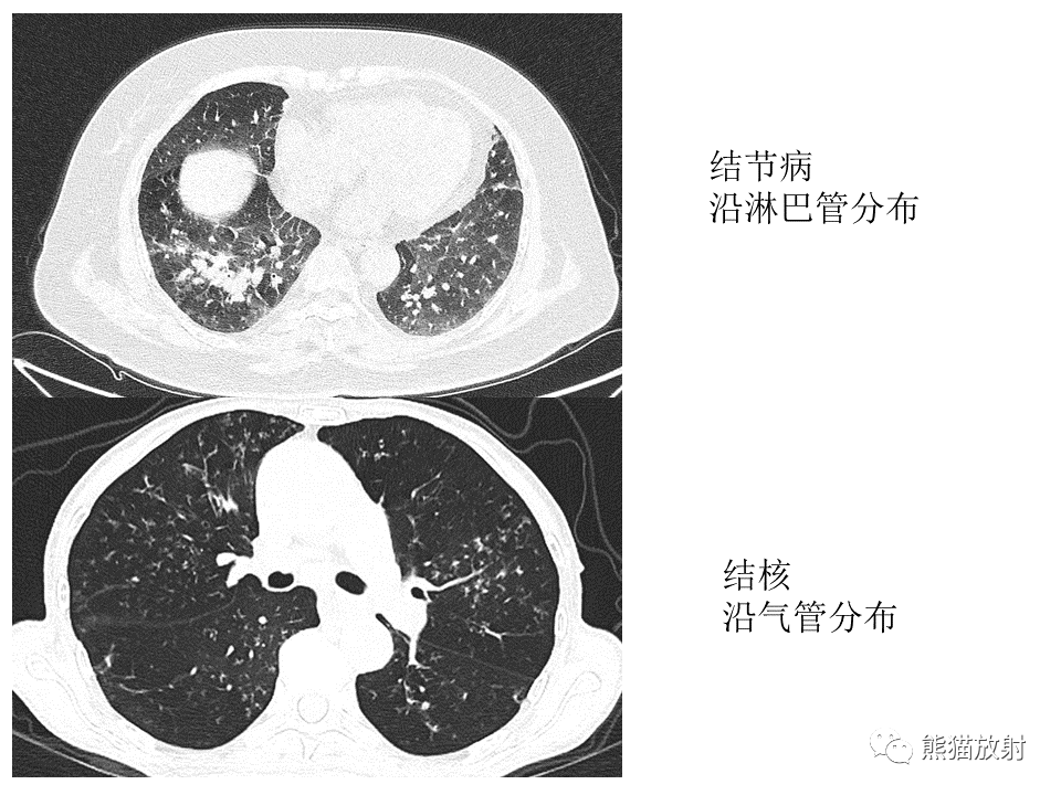 影像PPT - 【病例】肺结核肉芽肿 VS 肺腺癌-39
