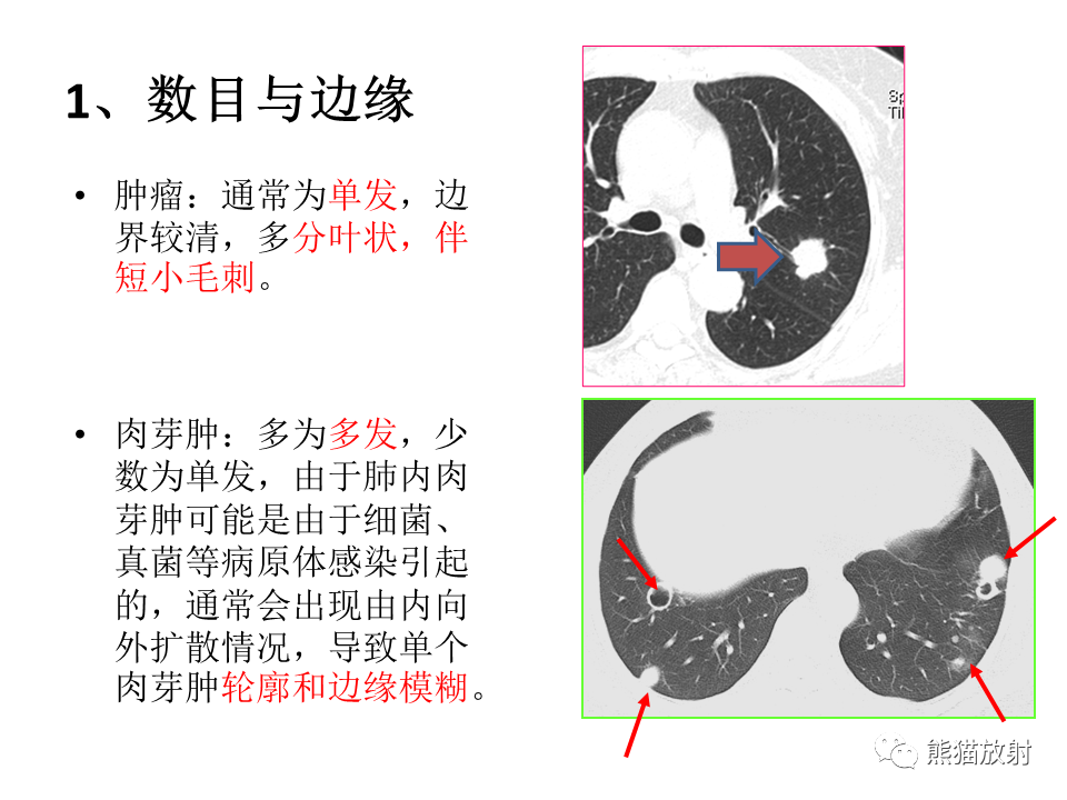 影像PPT - 【病例】肺结核肉芽肿 VS 肺腺癌-42