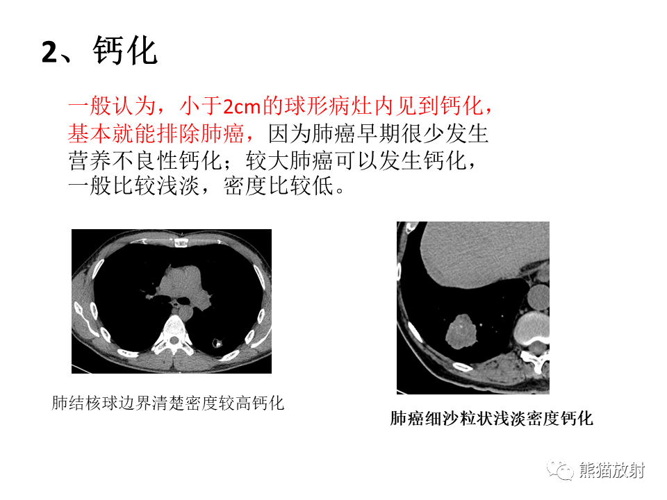 影像PPT - 【病例】肺结核肉芽肿 VS 肺腺癌-43