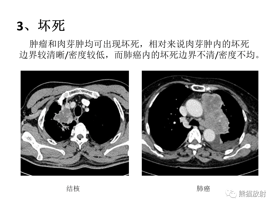 影像PPT - 【病例】肺结核肉芽肿 VS 肺腺癌-44