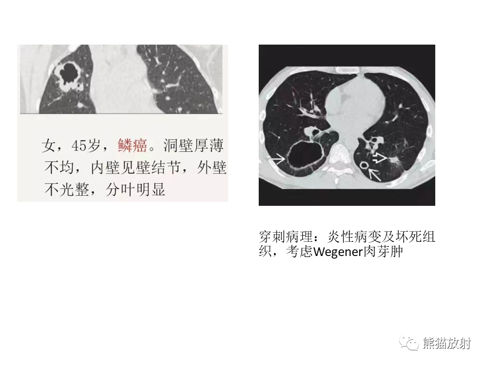 影像PPT - 【病例】肺结核肉芽肿 VS 肺腺癌-46