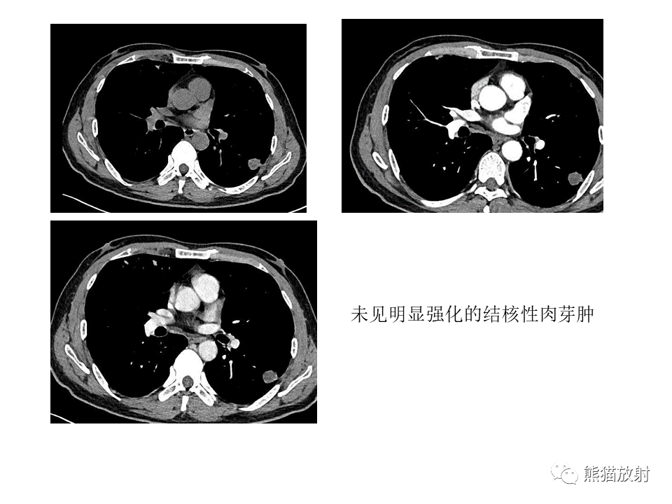影像PPT - 【病例】肺结核肉芽肿 VS 肺腺癌-48