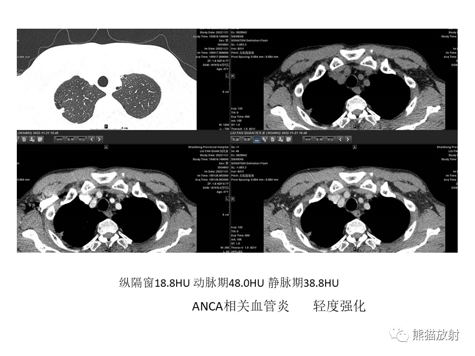 影像PPT - 【病例】肺结核肉芽肿 VS 肺腺癌-49