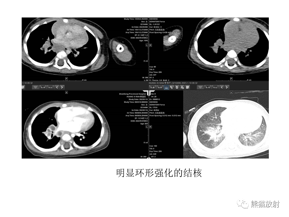 影像PPT - 【病例】肺结核肉芽肿 VS 肺腺癌-50