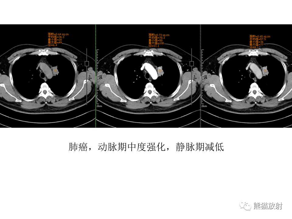 影像PPT - 【病例】肺结核肉芽肿 VS 肺腺癌-51