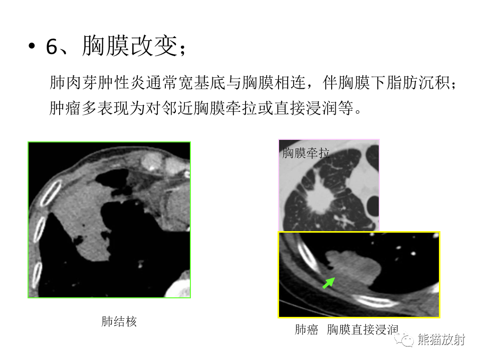 影像PPT - 【病例】肺结核肉芽肿 VS 肺腺癌-52