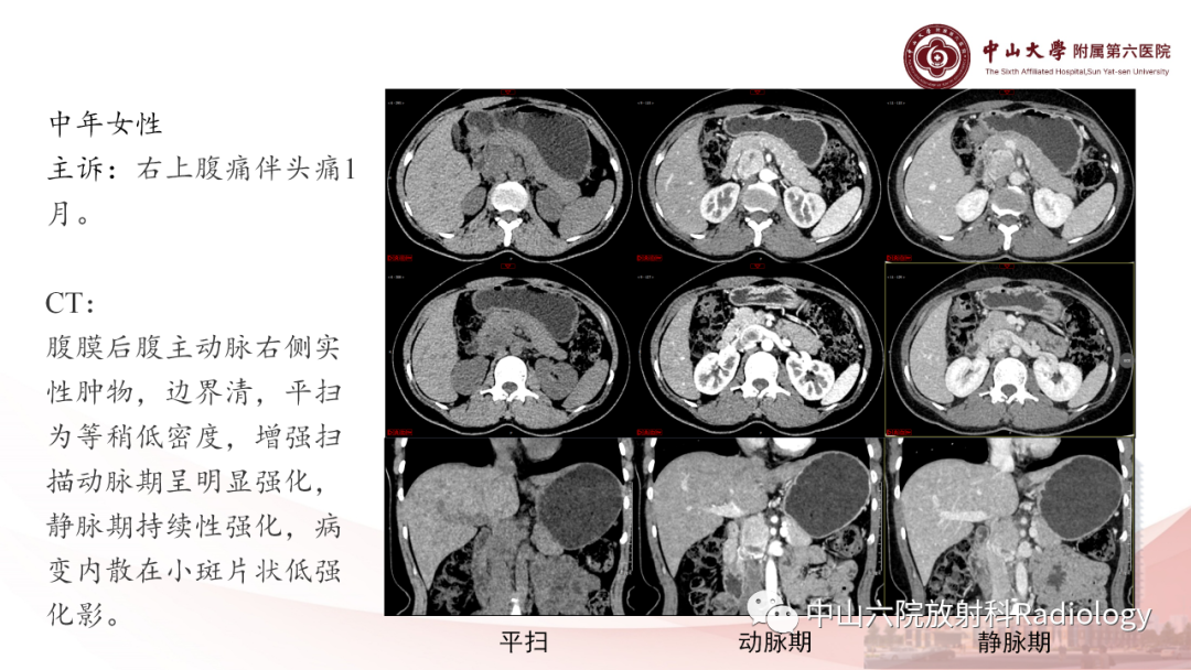 影像PPT - 【PPT】 副神经节瘤影像表现-2
