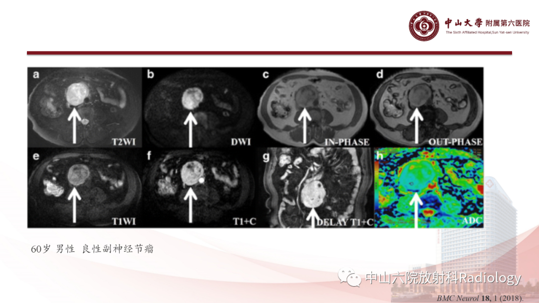 影像PPT - 【PPT】 副神经节瘤影像表现-15