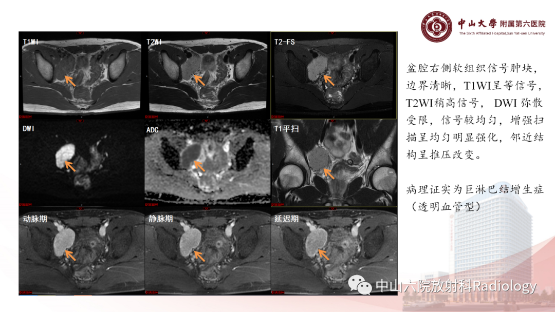 影像PPT - 【PPT】 副神经节瘤影像表现-20