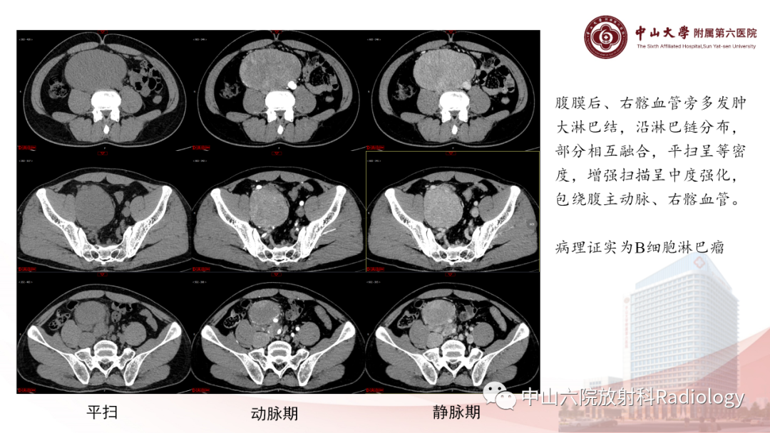 影像PPT - 【PPT】 副神经节瘤影像表现-22