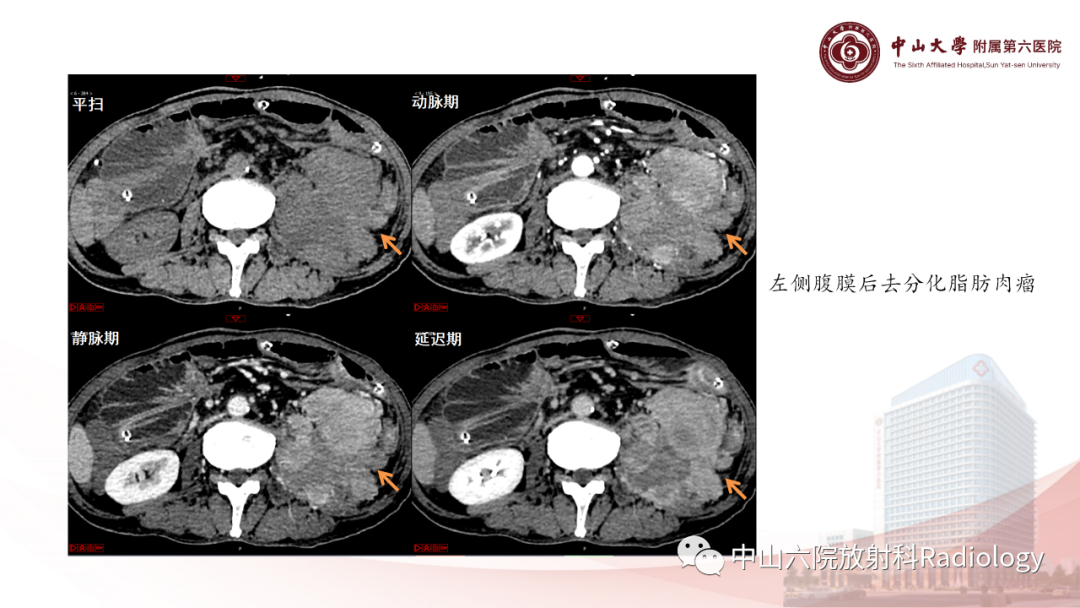 影像PPT - 【PPT】 副神经节瘤影像表现-24