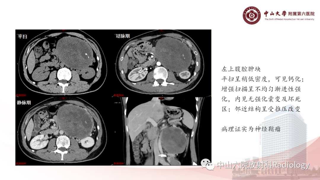 影像PPT - 【PPT】 副神经节瘤影像表现-28