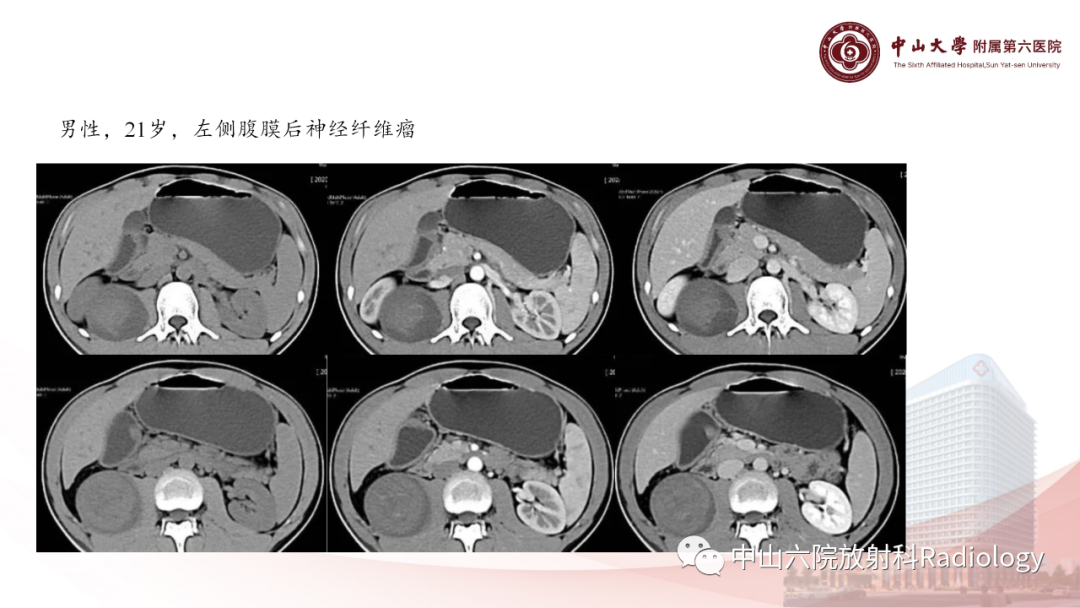 影像PPT - 【PPT】 副神经节瘤影像表现-30