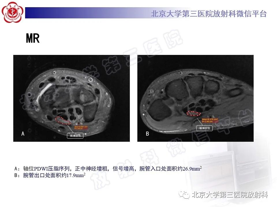影像PPT - 【PPT】腕管综合征-3