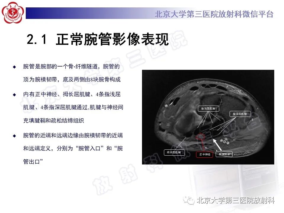 影像PPT - 【PPT】腕管综合征-12