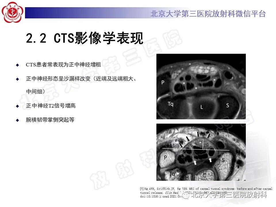 影像PPT - 【PPT】腕管综合征-13