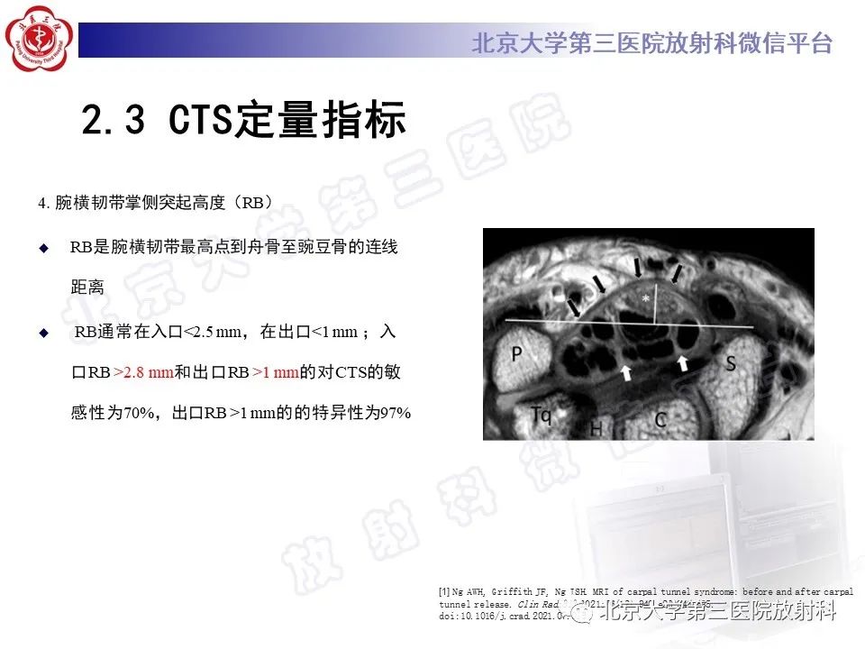 影像PPT - 【PPT】腕管综合征-16