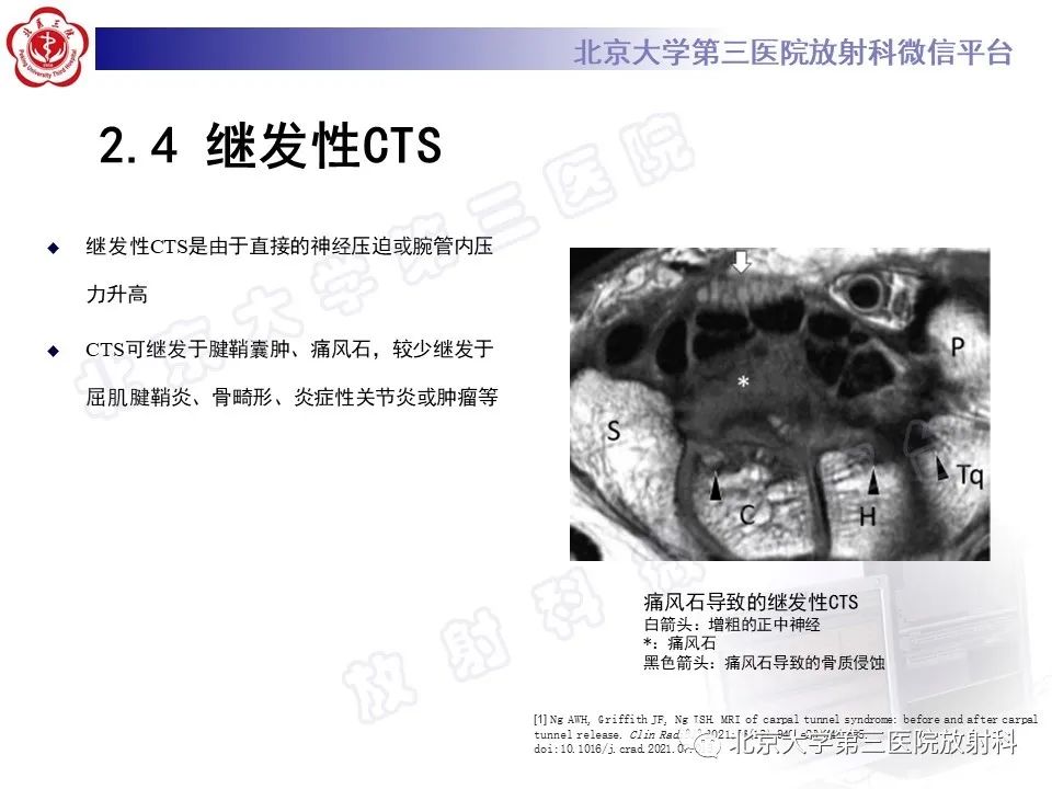 影像PPT - 【PPT】腕管综合征-17