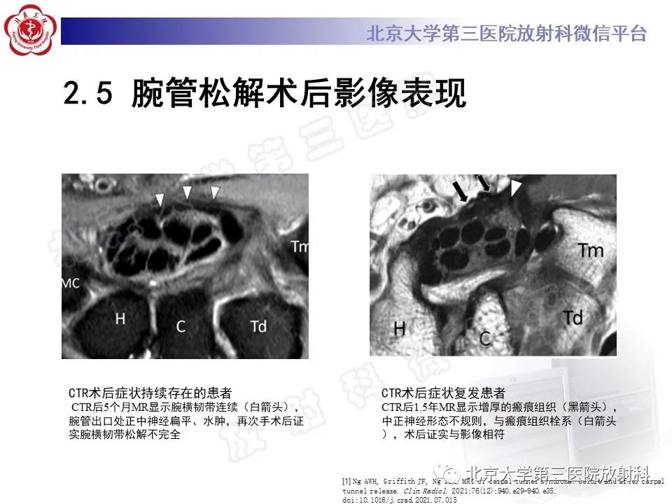 影像PPT - 【PPT】腕管综合征-20