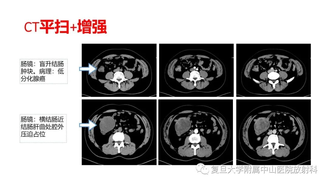 影像PPT - 【病例】肠系膜侵袭性纤维瘤病1例CT及MR影像-3