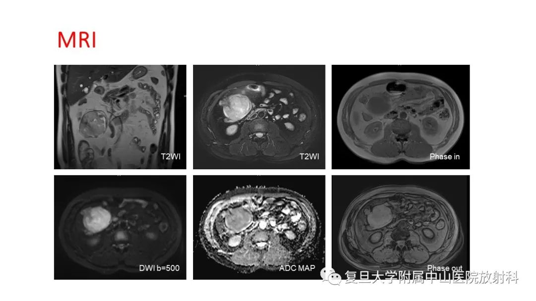 影像PPT - 【病例】肠系膜侵袭性纤维瘤病1例CT及MR影像-4