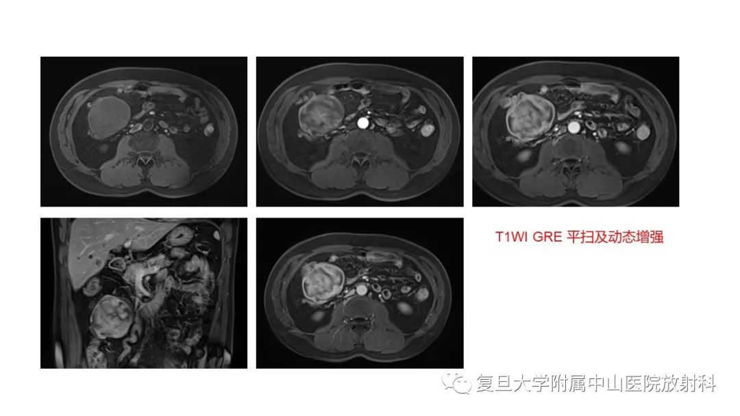 影像PPT - 【病例】肠系膜侵袭性纤维瘤病1例CT及MR影像-5