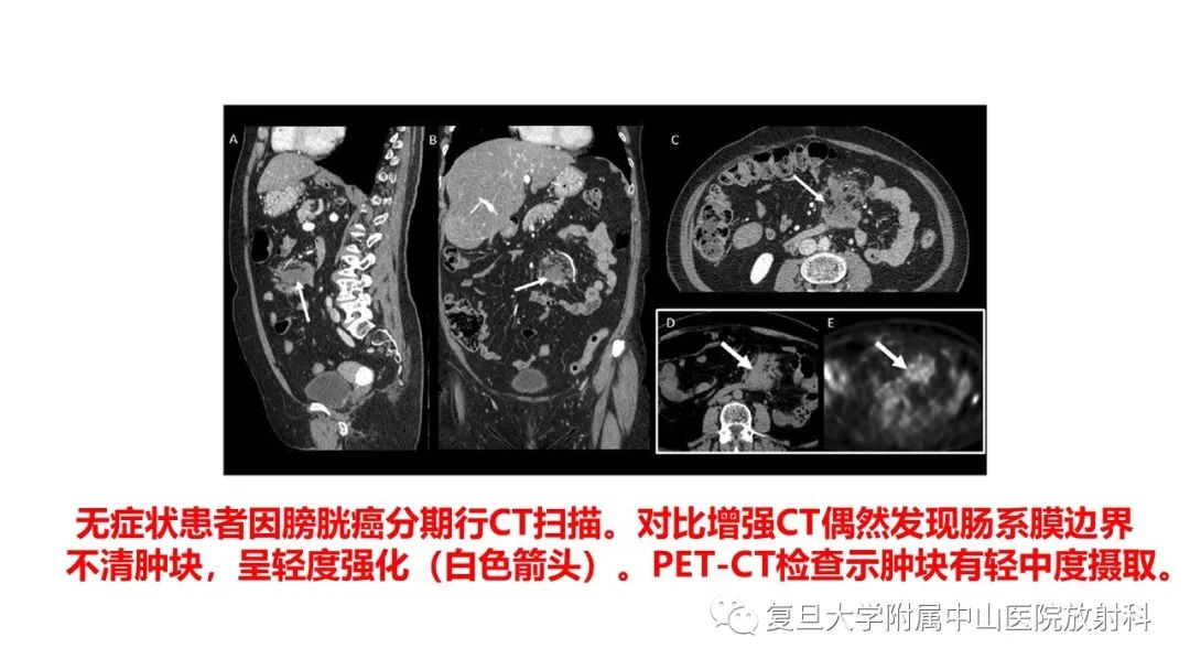 影像PPT - 【病例】肠系膜侵袭性纤维瘤病1例CT及MR影像-9