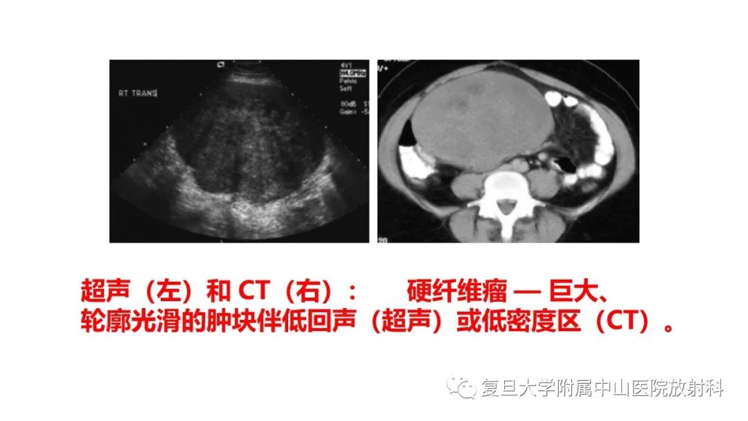 影像PPT - 【病例】肠系膜侵袭性纤维瘤病1例CT及MR影像-10
